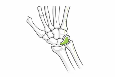 Triangular Fibrocartilage Complex TFCC mebocare