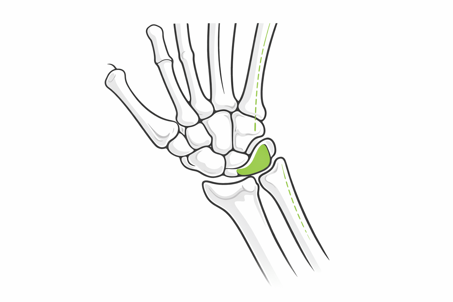 Triangular_Fibrocartilage_Complex_TFCC_mebocare