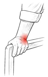 Ulnar-sided wrist pain when pushing up from a chair, common symptom of TFCC injury