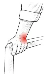 Ulnar-sided wrist pain when pushing up from a chair, common symptom of TFCC injury
