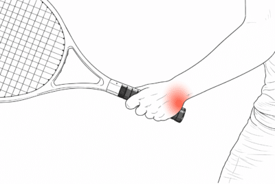 TFCC wrist pain during a tennis swing on the ulnar side of the wrist